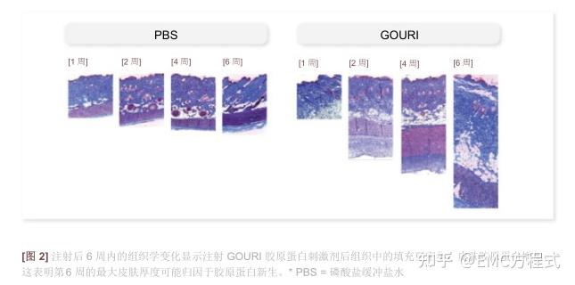 全球首款液态PCL GOURI格奥润 提升线雕 第四代少女 激活胶原新生(图12) 全球首款液态PCL GOURI格奥润 提升线雕 第四代少女 激活胶原新生(图12)