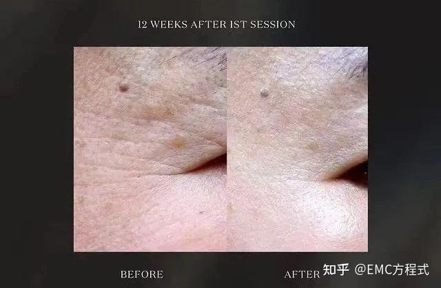 全球首款液态PCL GOURI格奥润 提升线雕 第四代少女 激活胶原新生(图25) 全球首款液态PCL GOURI格奥润 提升线雕 第四代少女 激活胶原新生(图25)