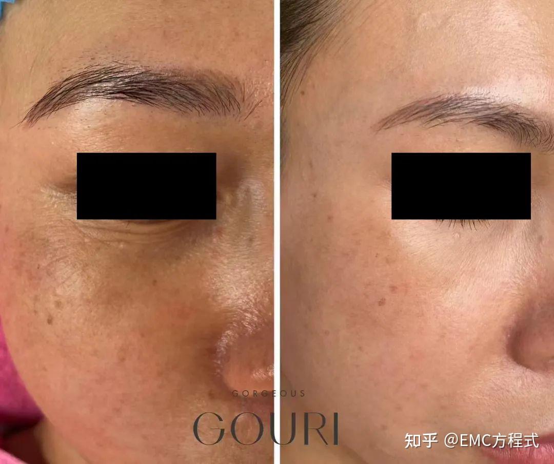 全球首款液态PCL GOURI格奥润 提升线雕 第四代少女 激活胶原新生(图24) 全球首款液态PCL GOURI格奥润 提升线雕 第四代少女 激活胶原新生(图24)
