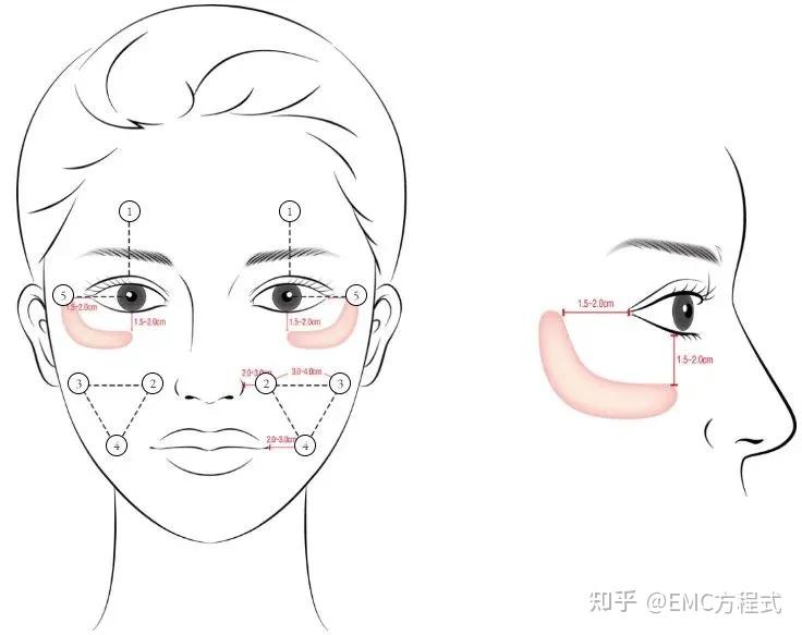 全球首款液态PCL GOURI格奥润 提升线雕 第四代少女 激活胶原新生(图21) 全球首款液态PCL GOURI格奥润 提升线雕 第四代少女 激活胶原新生(图21)