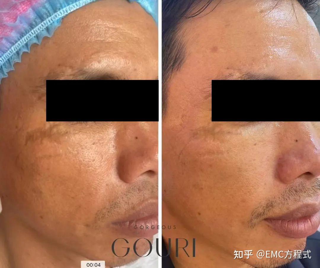 全球首款液态PCL GOURI格奥润 提升线雕 第四代少女 激活胶原新生(图23) 全球首款液态PCL GOURI格奥润 提升线雕 第四代少女 激活胶原新生(图23)