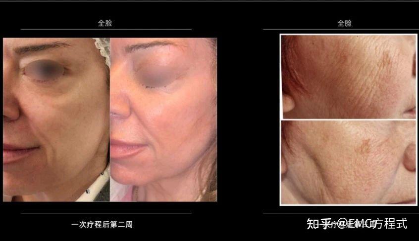 全球首款液态PCL GOURI格奥润 提升线雕 第四代少女 激活胶原新生(图26) 全球首款液态PCL GOURI格奥润 提升线雕 第四代少女 激活胶原新生(图26)