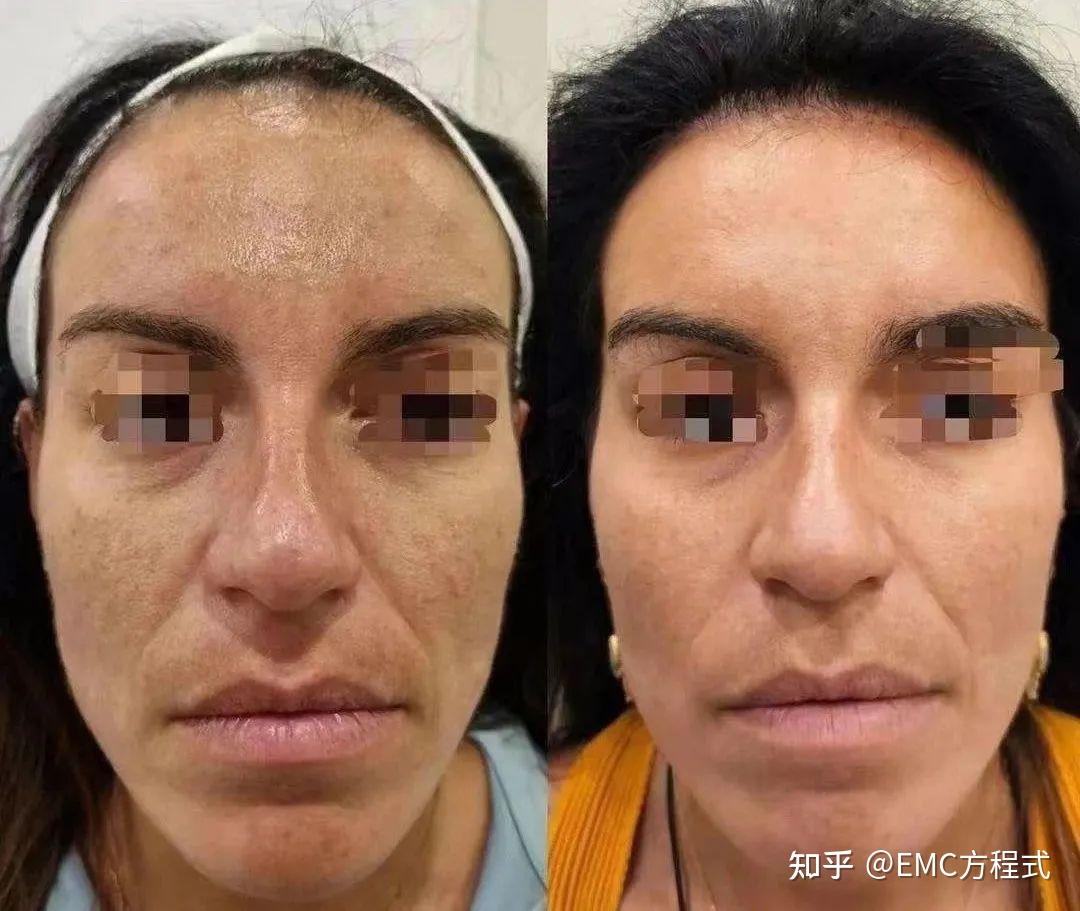 全球首款液态PCL GOURI格奥润 提升线雕 第四代少女 激活胶原新生(图27) 全球首款液态PCL GOURI格奥润 提升线雕 第四代少女 激活胶原新生(图27)