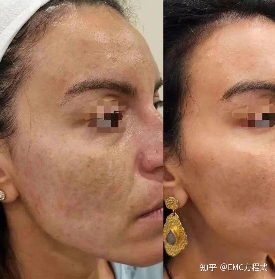 全球首款液态PCL GOURI格奥润 提升线雕 第四代少女 激活胶原新生(图28) 全球首款液态PCL GOURI格奥润 提升线雕 第四代少女 激活胶原新生(图28)